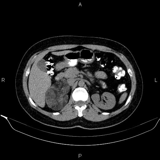 Bilateral adrenal myelolipoma (Radiopaedia 63058-71535 Axial non-contrast 58).jpg