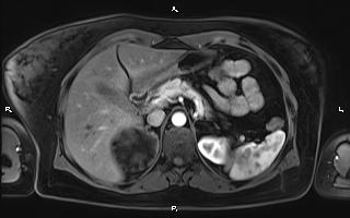 Bilateral adrenal myelolipoma (Radiopaedia 63058-71537 Axial T1 C+ fat sat 33).jpg