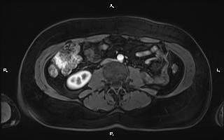 Bilateral adrenal myelolipoma (Radiopaedia 63058-71537 Axial T1 C+ fat sat 64).jpg