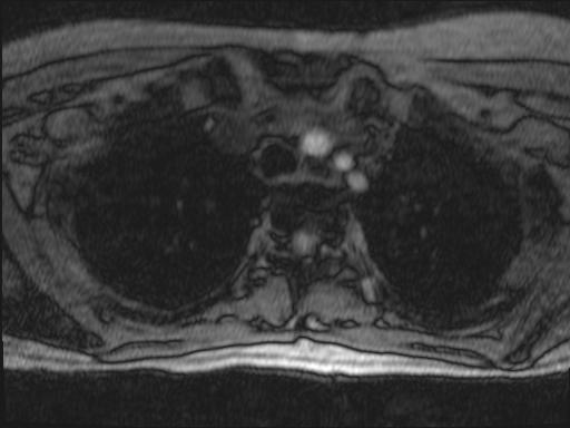 Bilateral carotid body tumors and right glomus jugulare tumor (Radiopaedia 20024-20060 Axial MRA 164).jpg