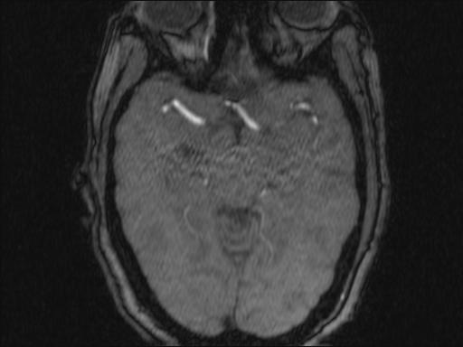 Bilateral carotid body tumors and right glomus jugulare tumor (Radiopaedia 20024-20060 Axial MRA 339).jpg