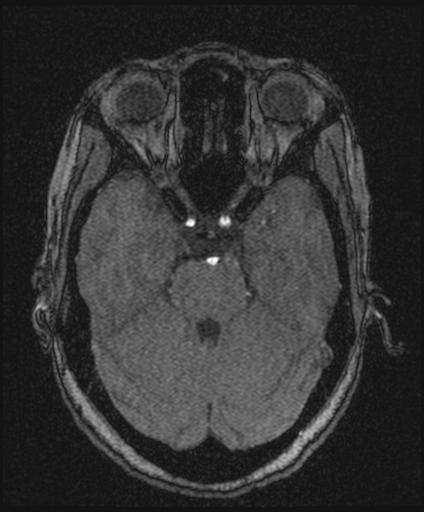 Bilateral carotid body tumors and right glomus jugulare tumor (Radiopaedia 20024-20060 Axial MRA 61).jpg