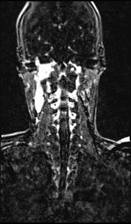 File:Bilateral carotid body tumors and right glomus jugulare tumor (Radiopaedia 20024-20060 MRA 115).jpg