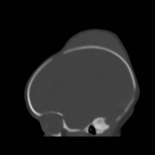 File:Bilateral cephalohematomas and subdural hematomas (Radiopaedia 26778-26929 Sagittal bone window 11).jpg