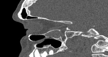 File:Bilateral ectopic infraorbital nerves (Radiopaedia 49006-54084 Sagittal 15).png