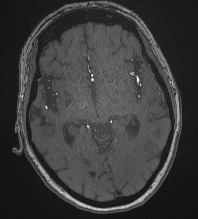 Bilateral fetal posterior communicating arteries (Radiopaedia 41286-44102 Axial MRA 99).png