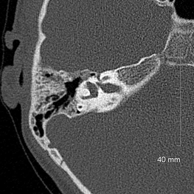 Bilateral grommets (Radiopaedia 47710-52404 Axial bone window 44).jpg