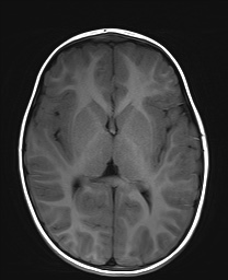 File:Bilateral mesial temporal polymicrogyria (Radiopaedia 76456-88181 Axial T1 13).jpg