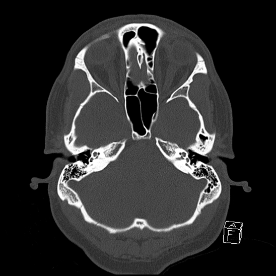 Bilateral occipital condyle fracture (type 2) (Radiopaedia 87675-104089 Axial bone window 30).jpg