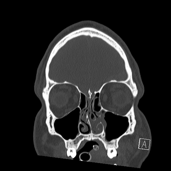 Bilateral occipital condyle fracture (type 2) (Radiopaedia 87675-104089 Coronal bone window 10).jpg
