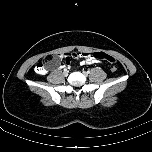 Bilateral ovarian teratoma (Radiopaedia 83131-97503 Axial With contrast 13).jpg