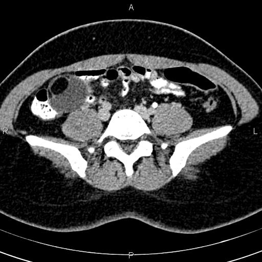 Bilateral ovarian teratoma (Radiopaedia 83131-97503 B 9).jpg