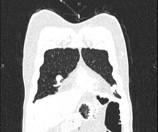 Bilateral pulmonary AVM (Radiopaedia 83134-97505 Coronal lung window 19).jpg