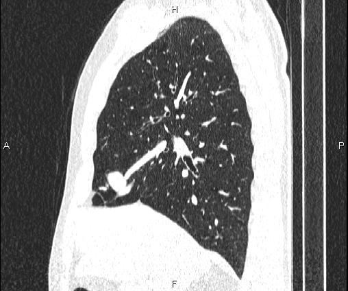 Bilateral pulmonary AVM (Radiopaedia 83134-97505 Sagittal lung window 45).jpg