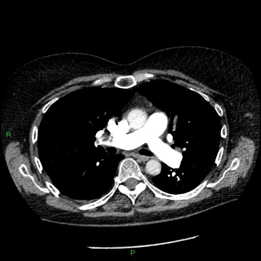 Bilateral pulmonary emboli (Radiopaedia 32700-33669 Axial C+ CTPA 47).jpg