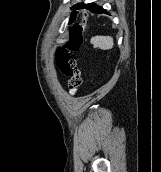 Bilateral rectus sheath hematomas (Radiopaedia 50778-56252 B 71).jpg
