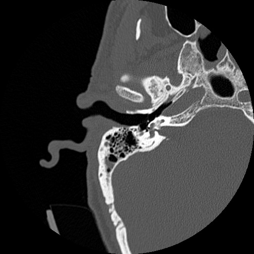 File:Bilateral temporal bone fractures (Radiopaedia 29482-29970 Axial non-contrast 14).jpg