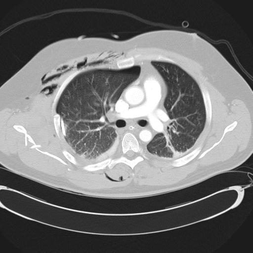 Bilateral traumatic renovascular injury (Radiopaedia 32051-32995 Axial lung window 23).jpg