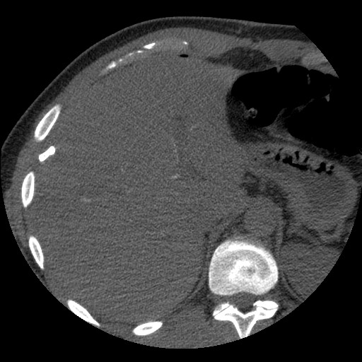 Bile leak from liver traumatic laceration (Radiopaedia 63463-72077 Axial Biliscopin 28).jpg