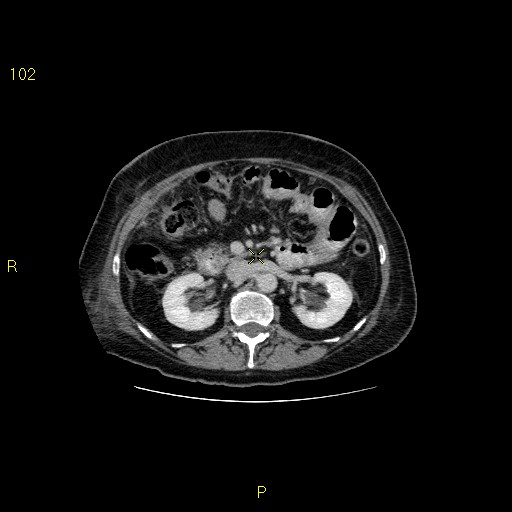 File:Biloma with drainage into the colon (Radiopaedia 20032-20068 A 1).jpg