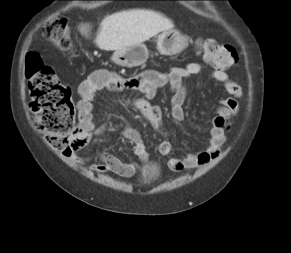 File:Bladder papillary urothelial carcinoma (Radiopaedia 48119-52951 C 17).png