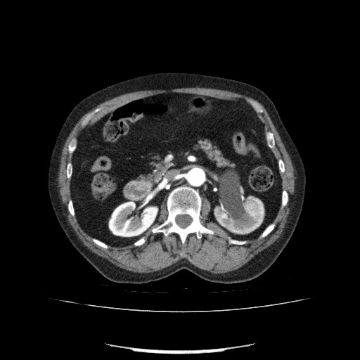 File:Bladder tumor detected on trauma CT (Radiopaedia 51809-57609 A 102).jpg
