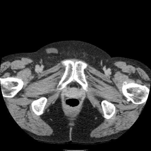 Bladder tumor detected on trauma CT (Radiopaedia 51809-57609 C 144).jpg