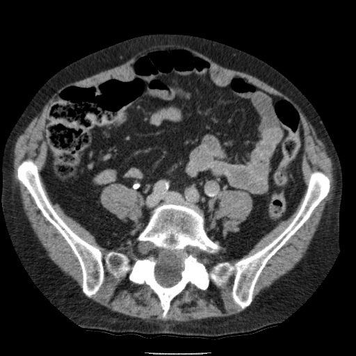 Bladder tumor detected on trauma CT (Radiopaedia 51809-57609 C 91).jpg