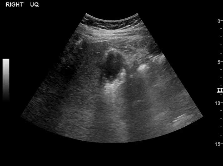 File:Bleeding duodenal ulcer and adenomyomatosis of gallbladder (Radiopaedia 61834-69873 A 4).jpg