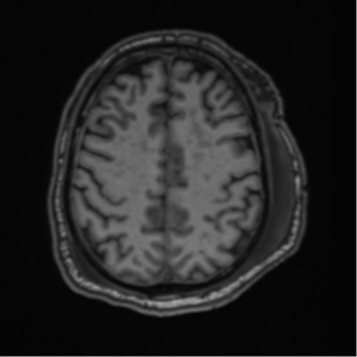 File:Blunt cerebrovascular injury (Radiopaedia 53682-59745 Axial T1 24).png