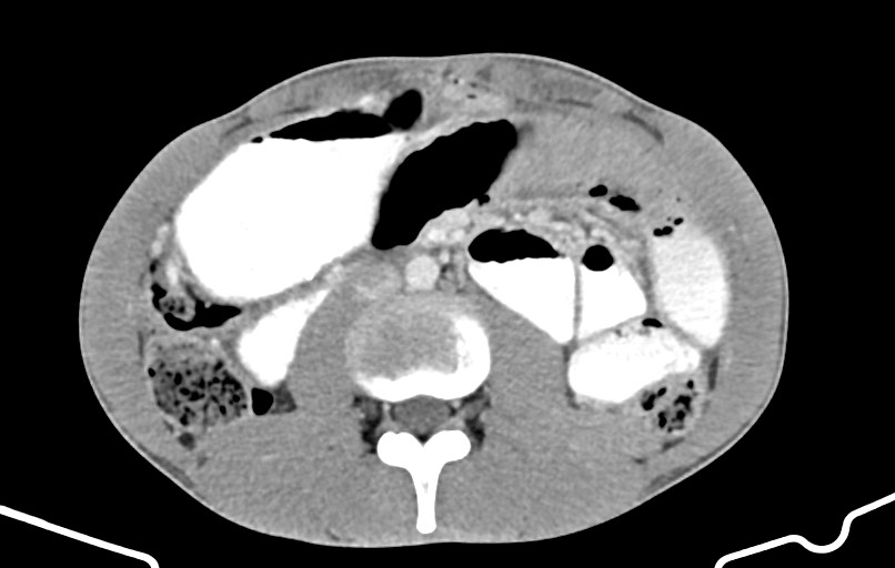 Blunt injury to the small bowel (Radiopaedia 74953-85987 A 88).jpg