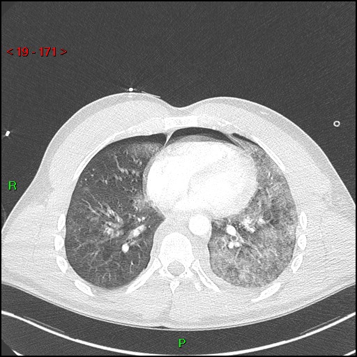 Blunt thoracic trauma (Radiopaedia 73454-84221 Axial lung window 63).jpg