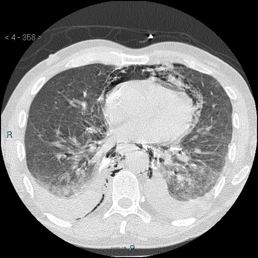 Boerhaave syndrome (Radiopaedia 27683-27897 lung window 58).jpg