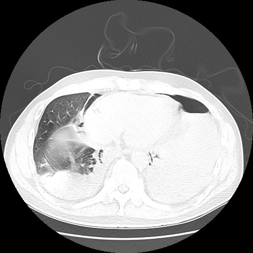 File:Boerhaave syndrome (Radiopaedia 59796-67310 Axial lung window 46).jpg
