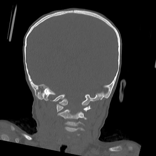 File:Bony atresia of the right external auditory canal (Radiopaedia 27916-28156 Coronal bone window 5).jpg