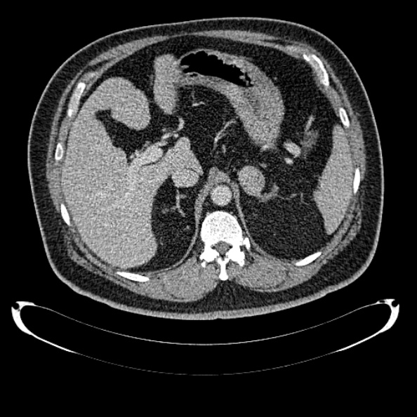Bosniak renal cyst - type IV (Radiopaedia 24244-24518 C 77).jpg