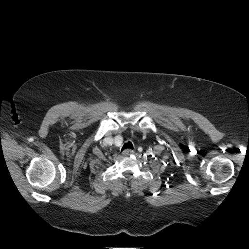 Bovine aortic arch - right internal mammary vein drains into the superior vena cava (Radiopaedia 63296-71875 A 7).jpg