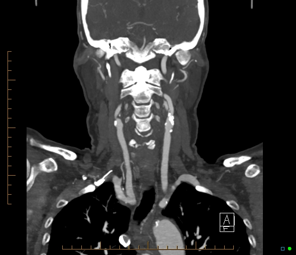 Brachiocephalic trunk stenosis (Radiopaedia 87242-103519 B 40).jpg