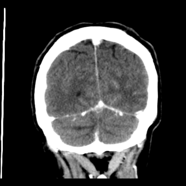 Brain metastases from lung cancer (Radiopaedia 24480-24781 Coronal C+ delayed 53).jpg