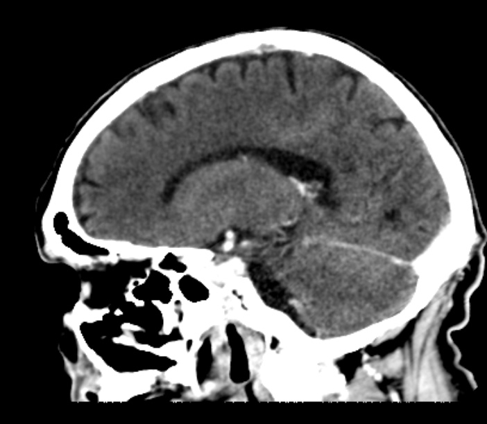 Brain metastases from lung cancer (Radiopaedia 27849-28092 Sagittal C+ delayed 38).jpg