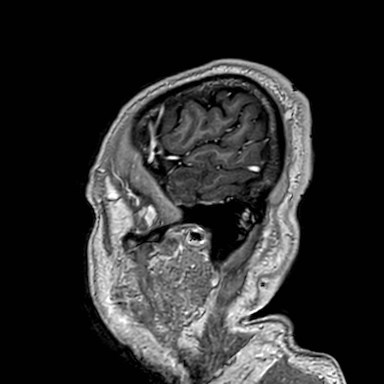 Brain metastases from lung cancer (Radiopaedia 83839-99028 Sagittal T1 C+ 60).jpg