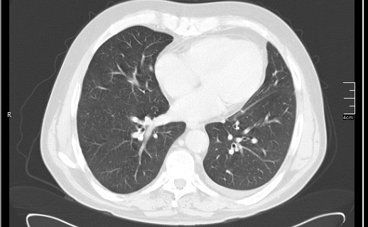 Brain metastases from squamocellular lung cancer (Radiopaedia 56515-63219 Axial lung window 42).jpg