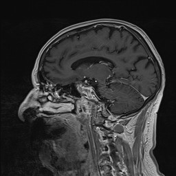 Brain metastasis (Radiopaedia 42617-45761 Sagittal T1 C+ 57).jpg
