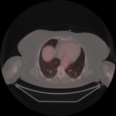 Brain metastasis (Radiopaedia 89847-106962 Axial lung window 42).jpg