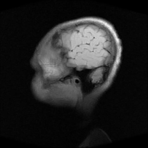 File:Brainstem glioma (Radiopaedia 30923-31624 Sagittal T1 2).jpg