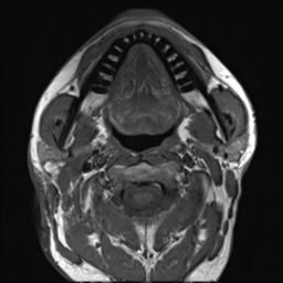 File:Branchial cleft cyst (Radiopaedia 31167-31876 Axial T1 17).jpg