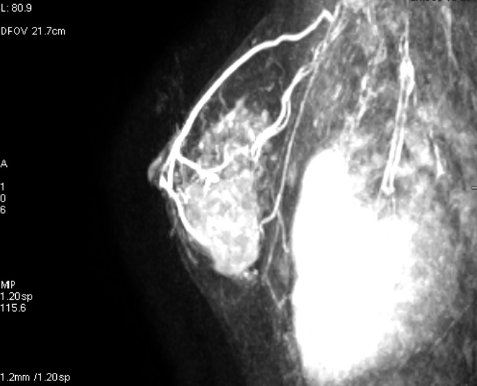 File:Breast lymphoma (MRI) (Radiopaedia 34999-36498 Sagittal MIP 1).jpeg