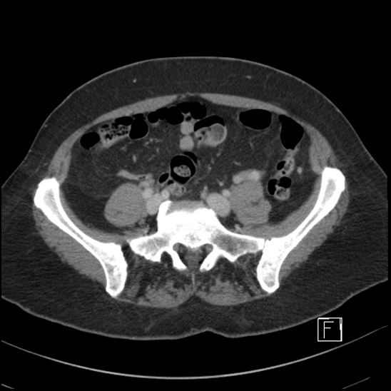 File:Breast metastases from renal cell cancer (Radiopaedia 79220-92225 C 80).jpg