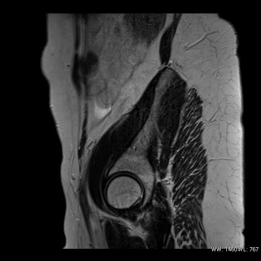 File:Broad ligament fibroid (Radiopaedia 49135-54241 Sagittal T2 1).jpg