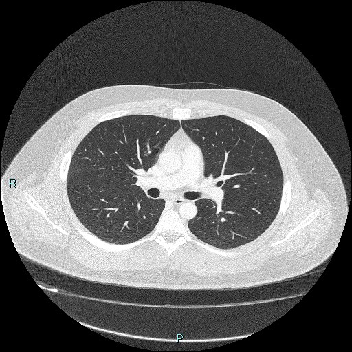 Bronchial carcinoid tumor (Radiopaedia 78272-90875 Axial lung window 21).jpg